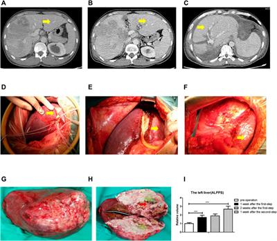 Mechanism of Liver Regeneration During ALPPS